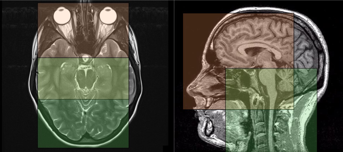 Thumbnail for Consistent View Alignment Improves Foundation Models for 3D Medical Image Segmentation